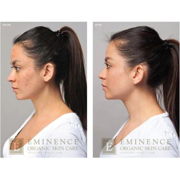 Eminence Acne Advanced 3 Step Treatment System - Image 3