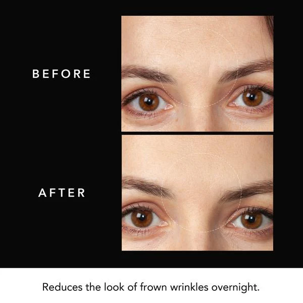 FOREO FAQ Forehead Microneedling Anti-Wrinkle Hyaluronic Acid Patches 3 Patches - Image 4