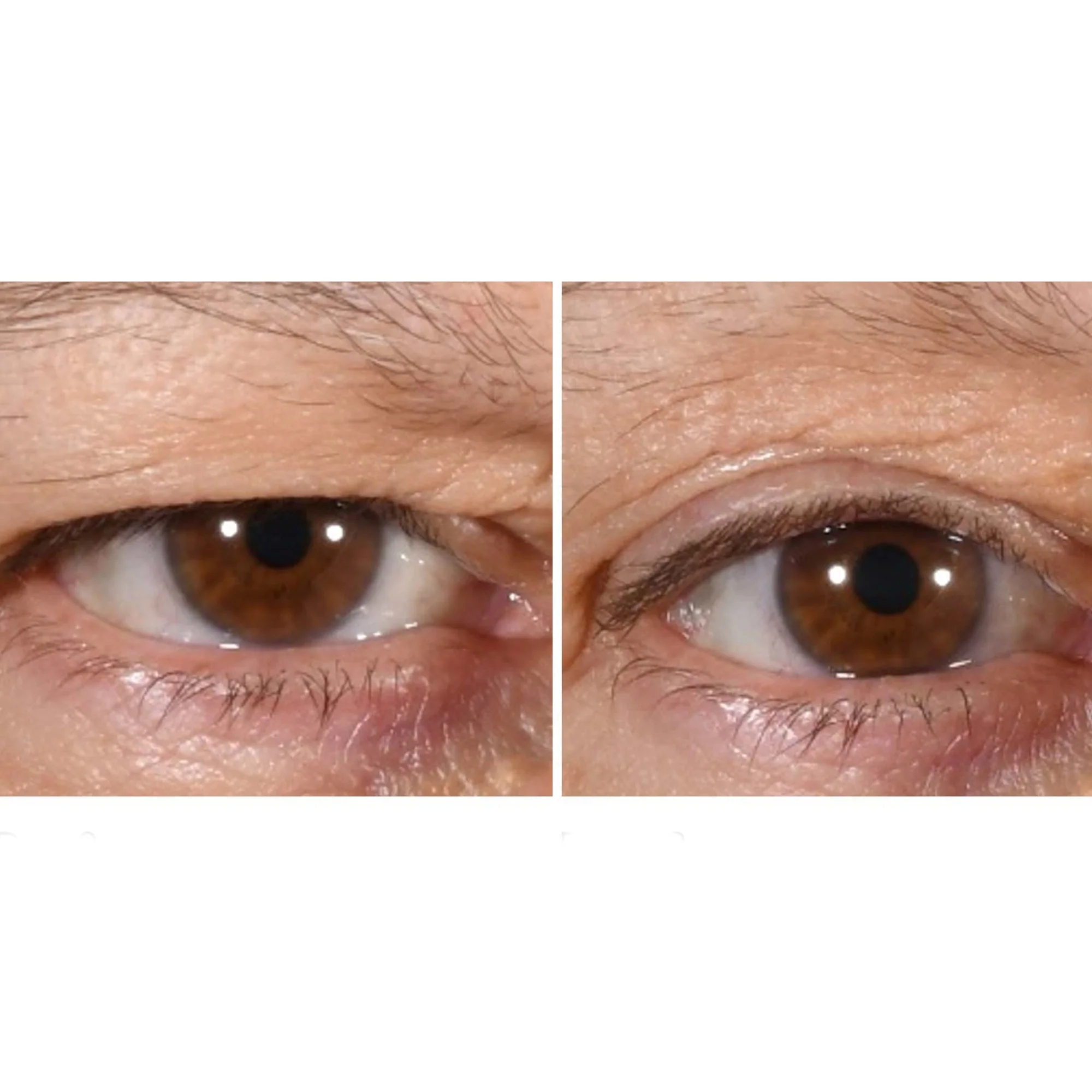 freezeframe Eyelid Lift 15ml - Image 2