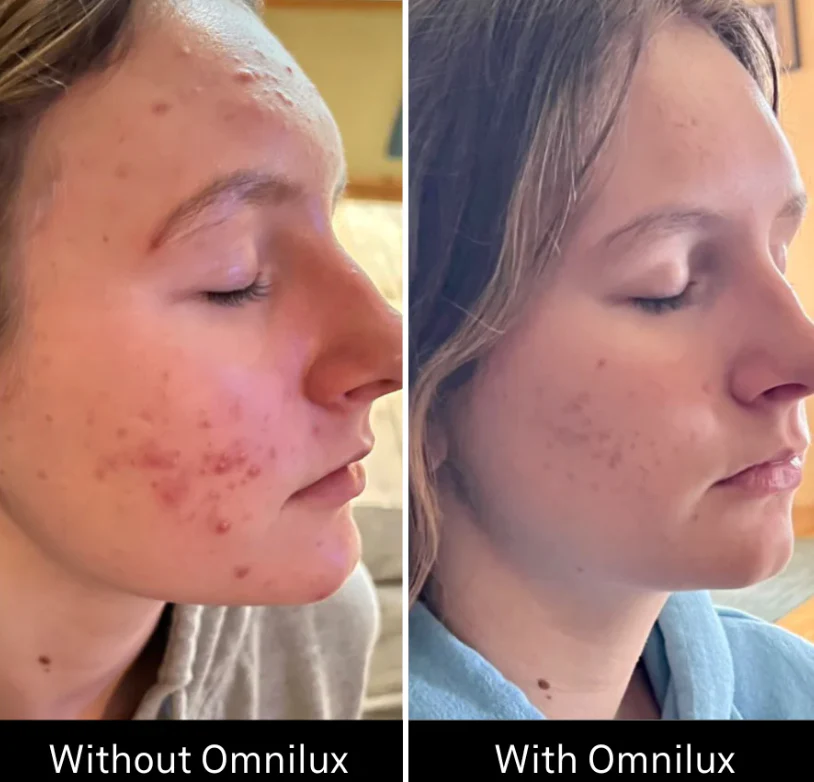 Omnilux Clear - Image 2