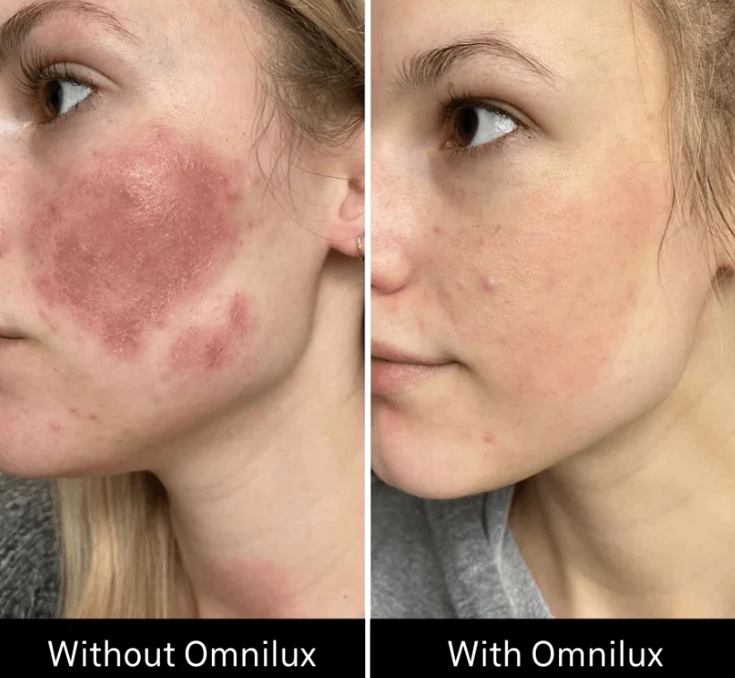 Omnilux Contour Face - Image 10
