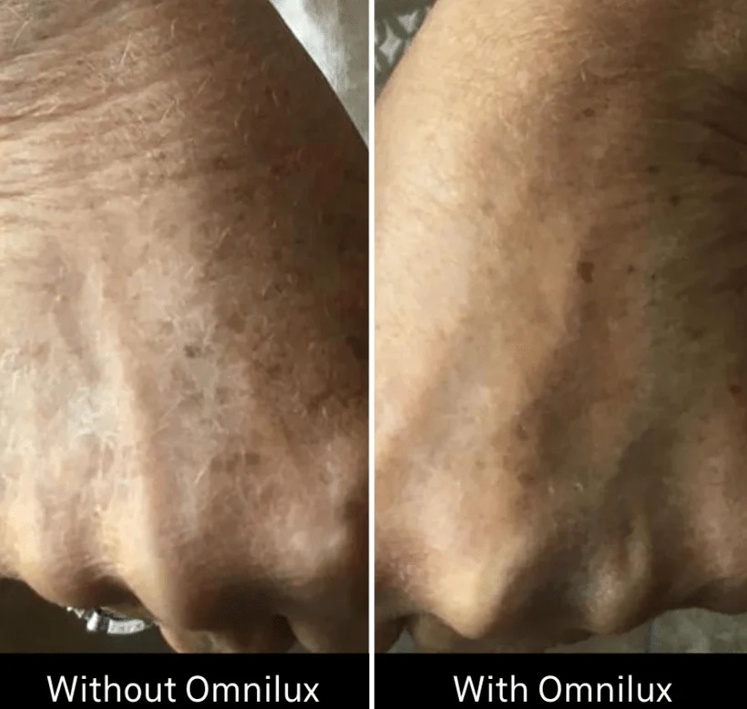 Omnilux Contour Glove - Image 11