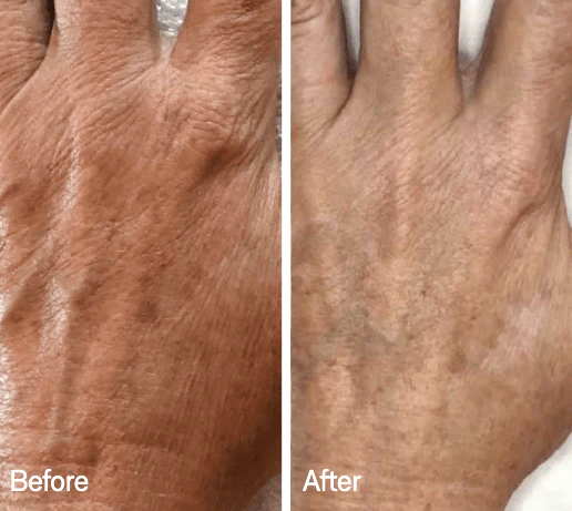 Omnilux Contour Glove - Image 2