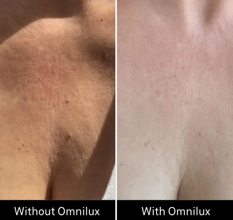 Omnilux Contour Neck & Décolleté - Image 13