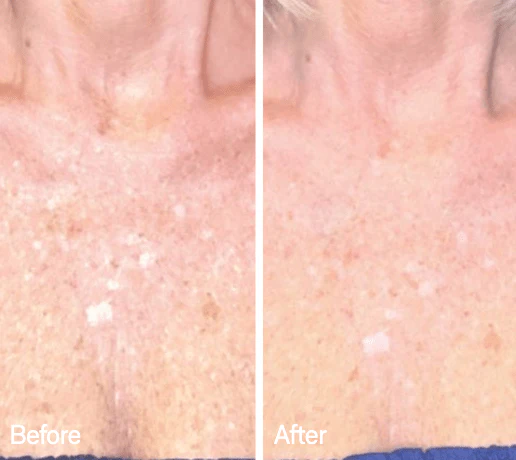 Omnilux Contour Neck & Décolleté - Image 3