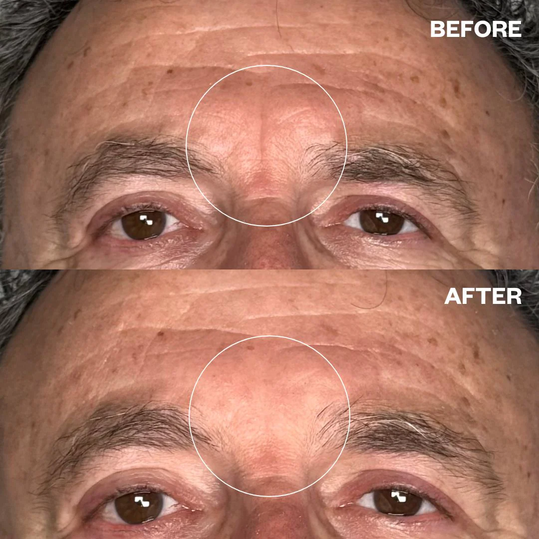 Wrinkles Schminkles Men's Pro Forehead Wrinkle Patches - 2 Patches - Image 3