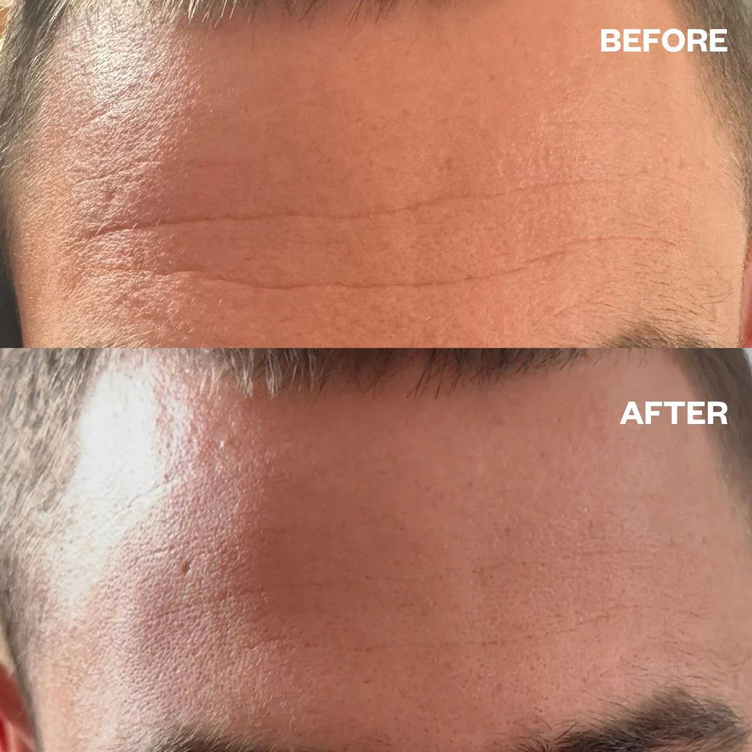 Wrinkles Schminkles Men's Pro Forehead Wrinkle Patches - 2 Patches - Image 4